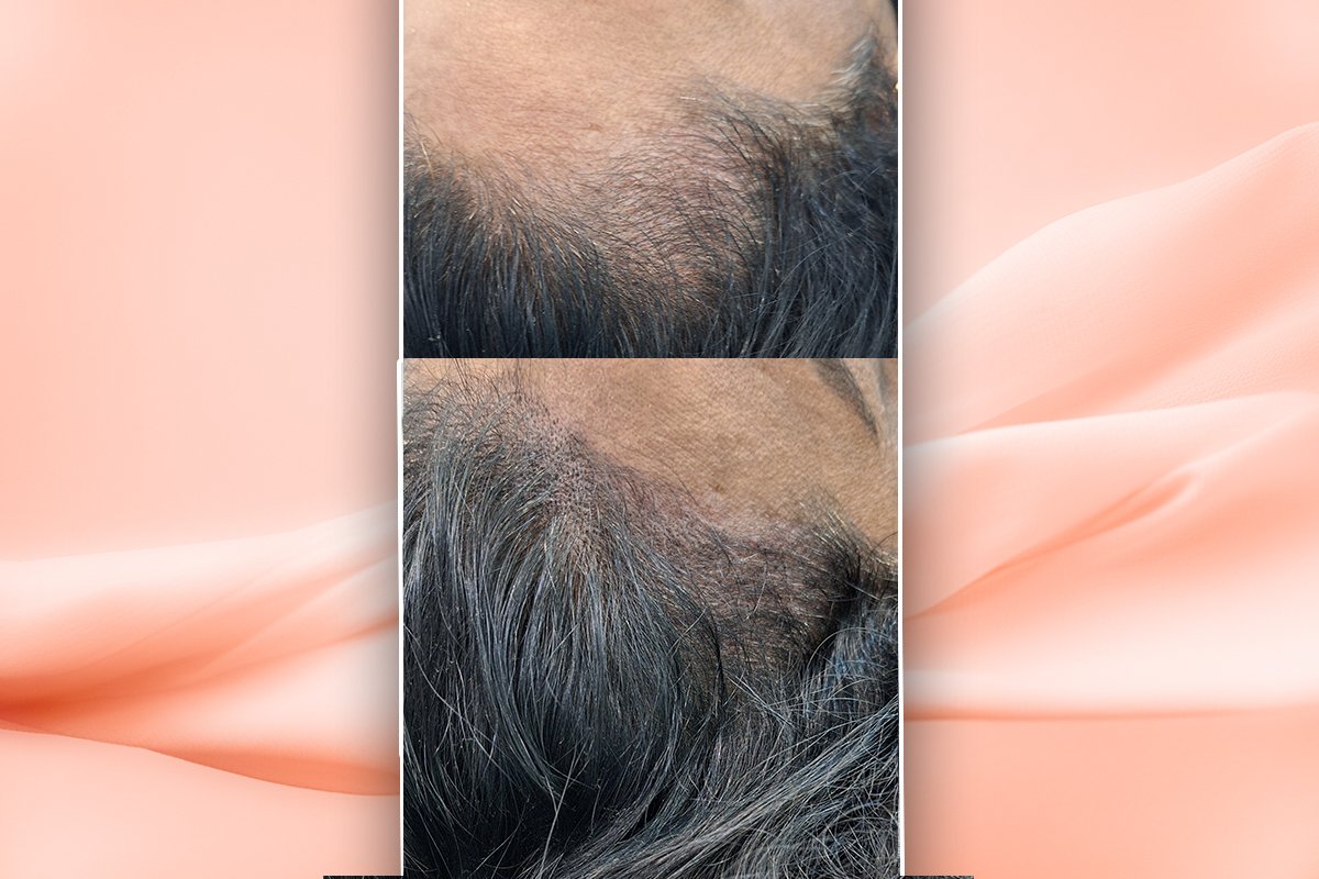 Scalp Micropigmentation